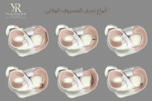 أنواع تمزق الغضروف الهلالي
