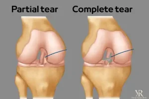 الفرق بين قطع وتمزق الرباط الصليبي