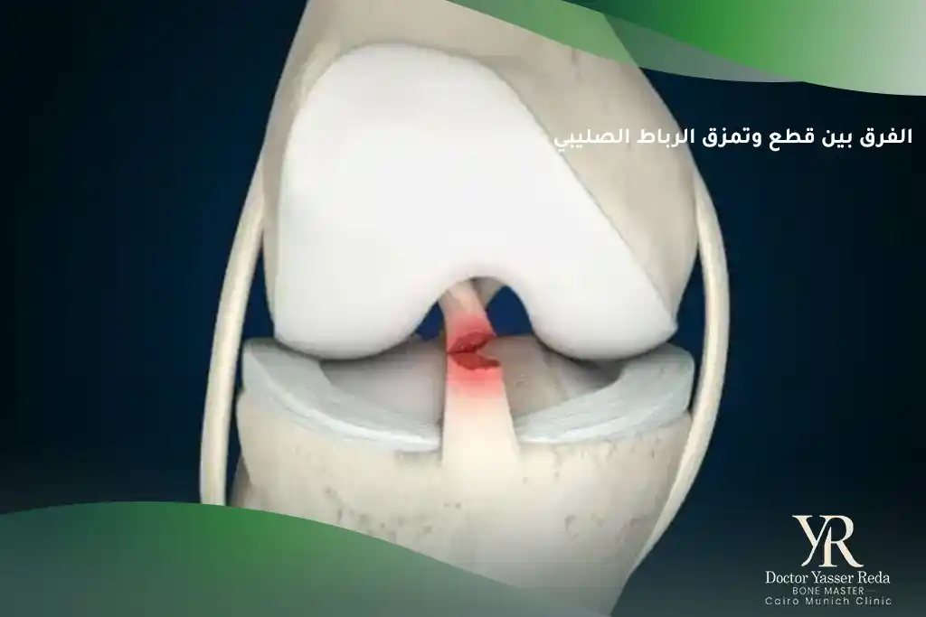 الفرق بين قطع وتمزق الرباط الصليبي