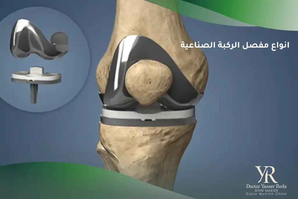 انواع مفصل الركبة الصناعية