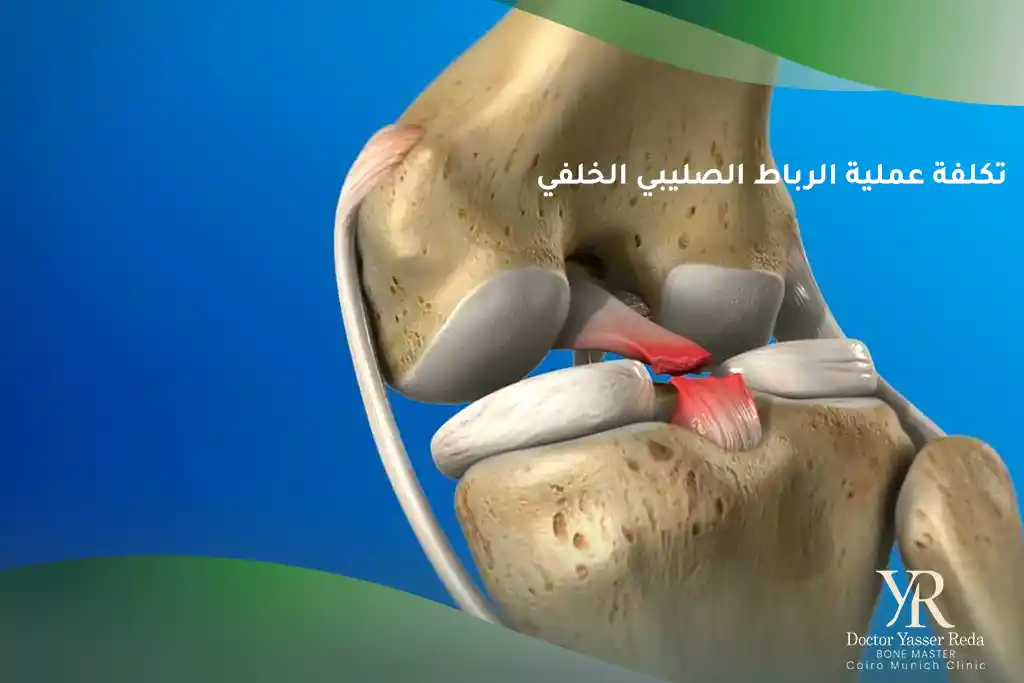 تكلفة عملية الرباط الصليبي الخلفي
