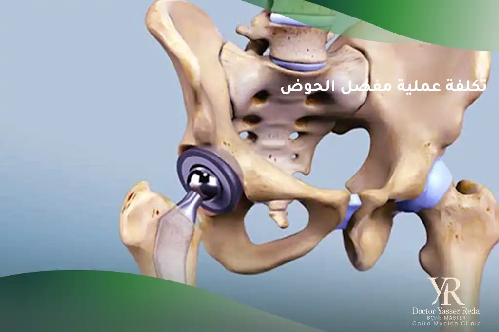 تكلفة عملية مفصل الحوض
