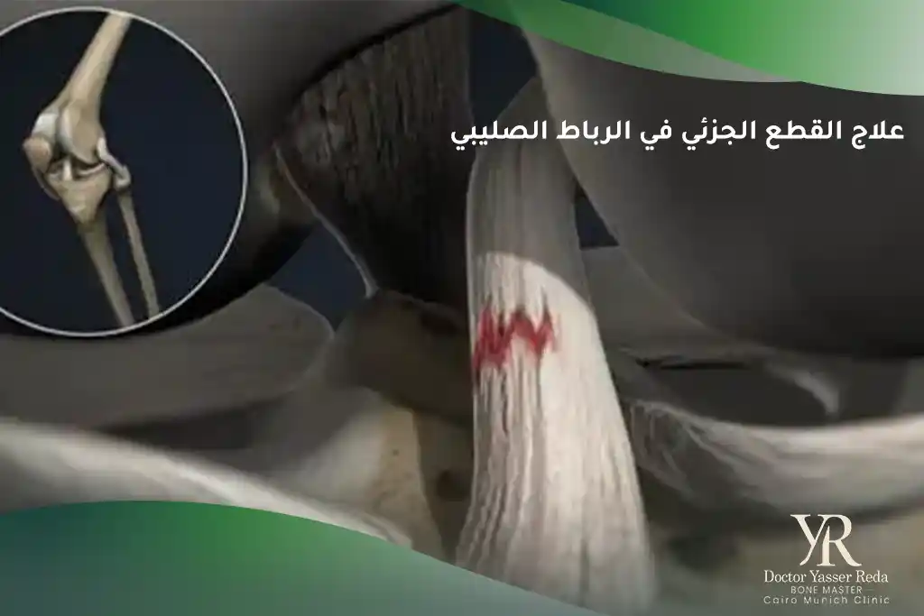 علاج القطع الجزئي في الرباط الصليبي