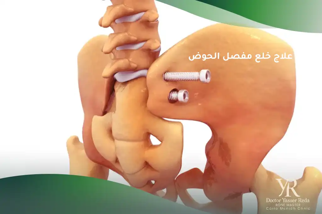علاج خلع مفصل الحوض