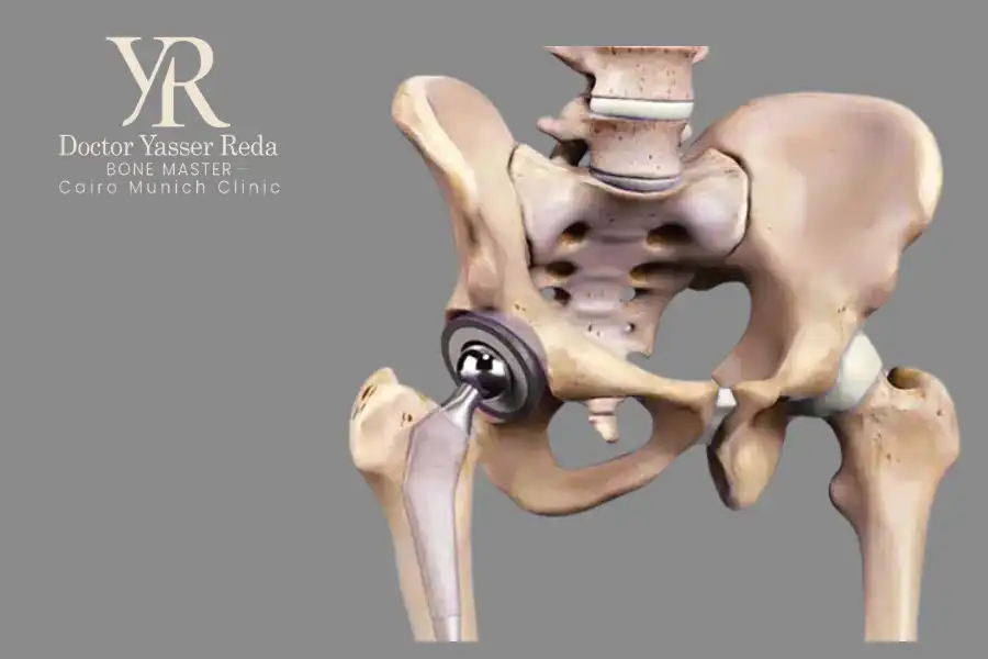 عملية تبديل مفصل الورك لكبار السن