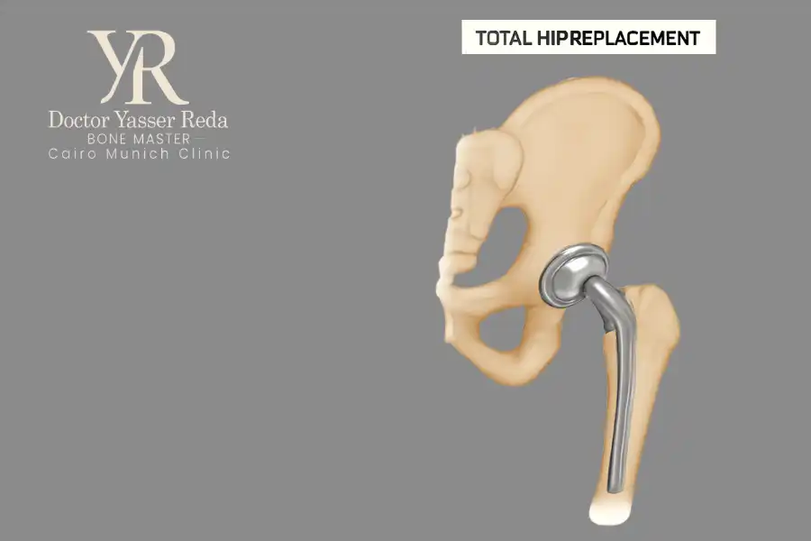 عملية تغيير مفصل الحوض الكاملة (Total Hip Replacement)