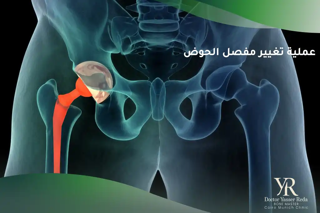 عملية تغيير مفصل الحوض