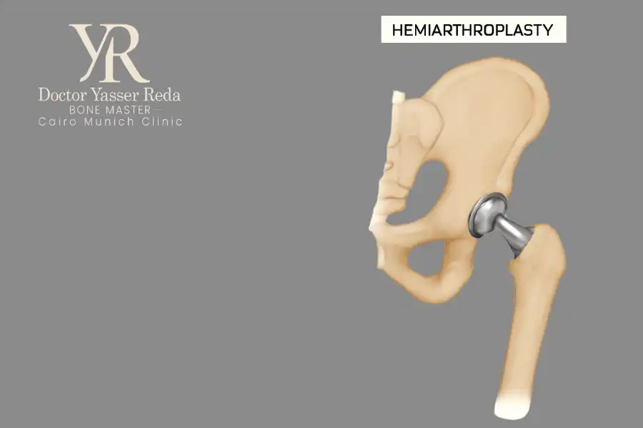 عملية تغيير نصف مفصل الحوض (Hemiarthroplasty)