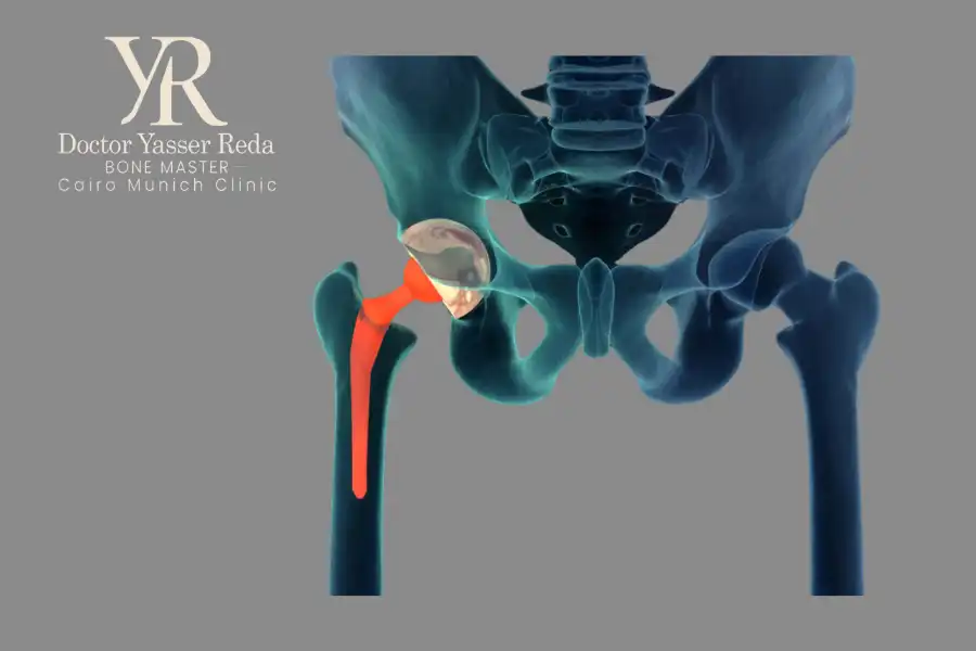 مفصل الفخد الصناعي