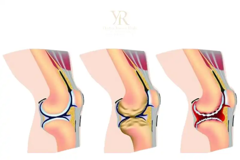 أسباب خشونة الركبة