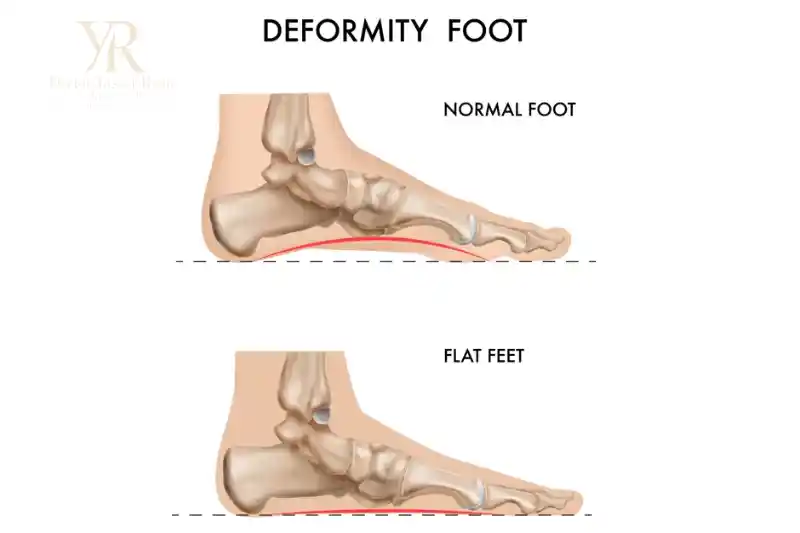 أعراض وأضرار الفلات فوت