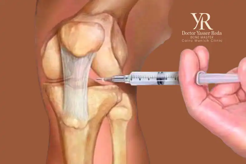 إجراء تقنية حقن الركبة لعلاج الخشونة
