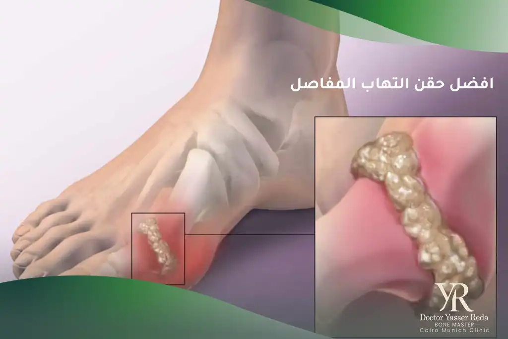 افضل حقن التهاب المفاصل