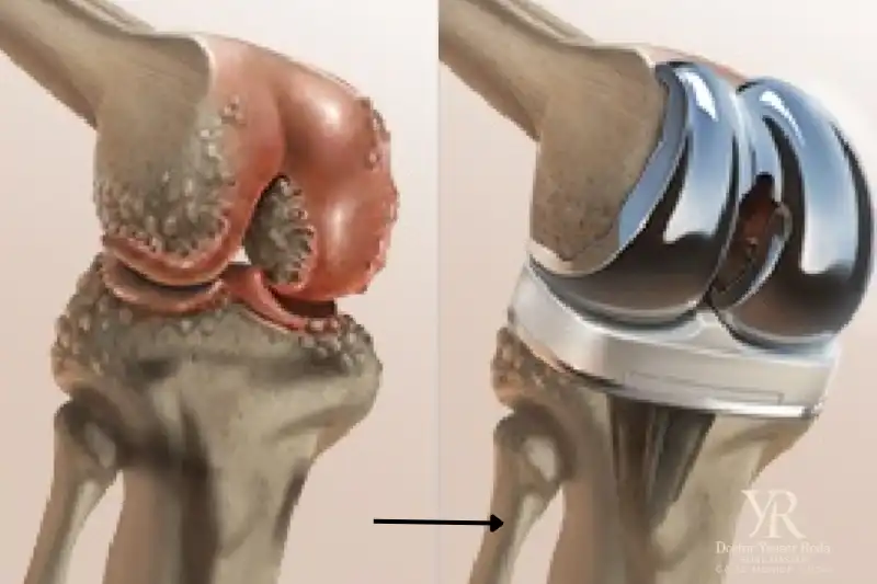 تبديل مفصل الركبة الاصطناعي