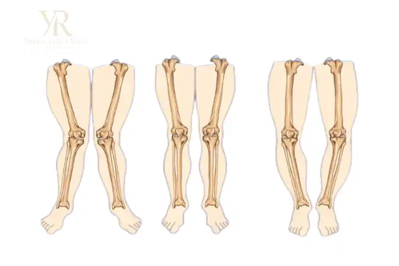 تقوس الساقين