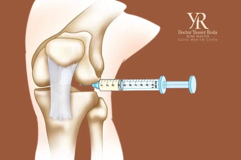 تكلفة عملية حقن الركبة وعلاج الخشونة
