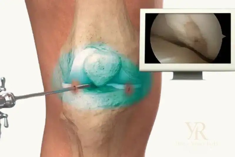 خشونة الركبة