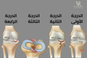 درجات تمزق الغضروف الهلالي