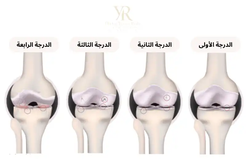درجات خشونة الركبة