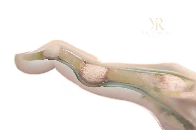 شكل كسر إصبع اليد الصغير