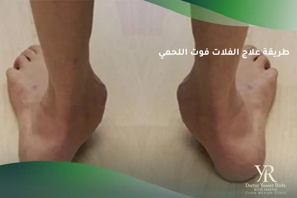 طريقة علاج الفلات فوت اللحمي