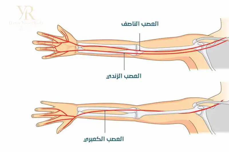 علاج اعتلال العصب الزندي