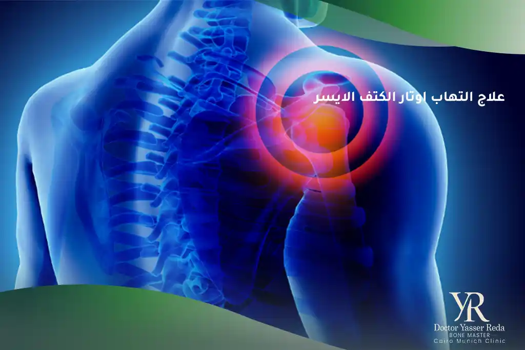 علاج التهاب اوتار الكتف الايسر