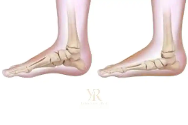 علاج الفلات فوت عند الاطفال