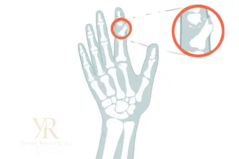 علامات كسر اصبع اليد