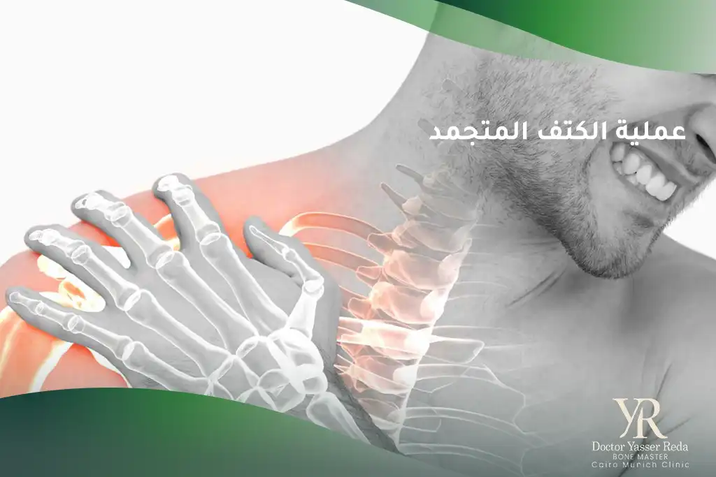 عملية الكتف المتجمد