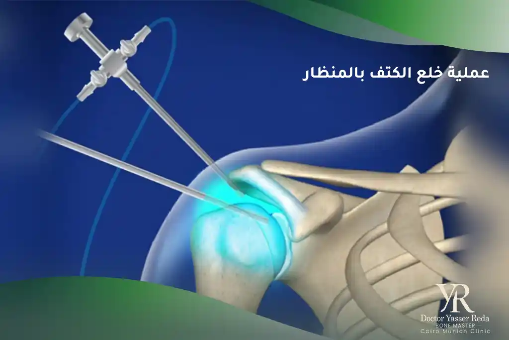 عملية خلع الكتف بالمنظار