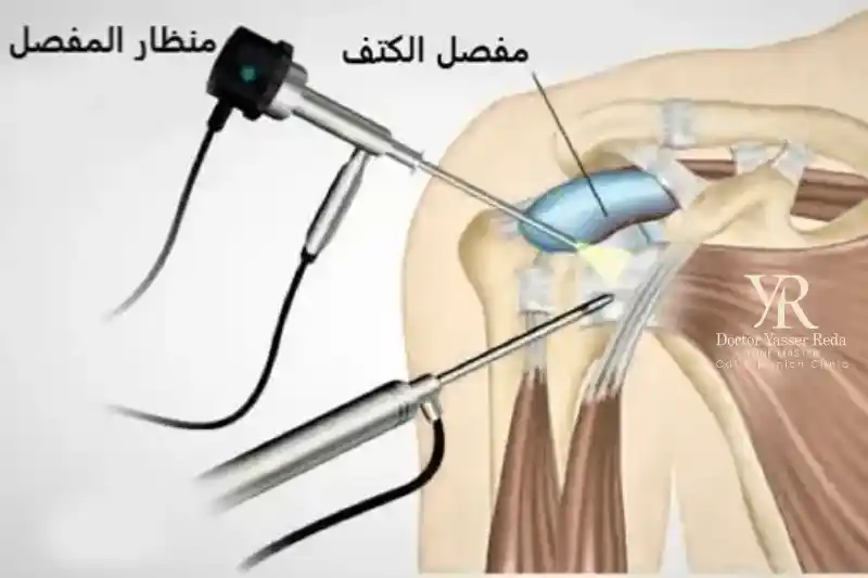 عيوب عملية منظار الكتف الجراحي