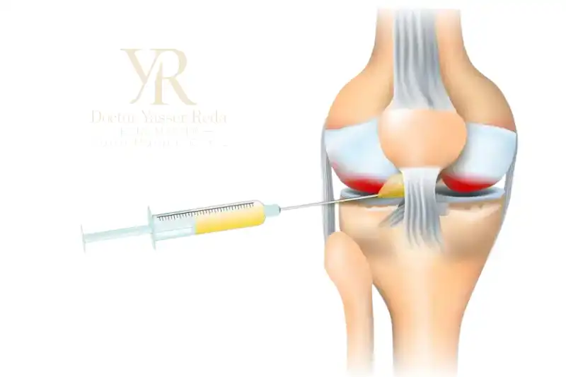 مفعول الحقن الجيلاتينية
