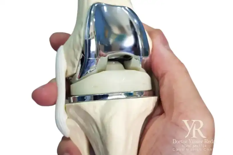 مكونات المفصل الصناعي للركبة