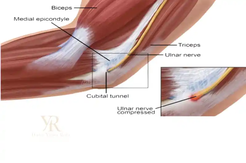 نسبة نجاح علاج العصب الزندي في اليد