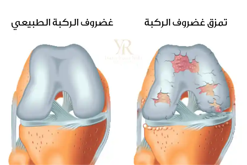 العلاج النهائي لتمزق الغضروف الهلالي