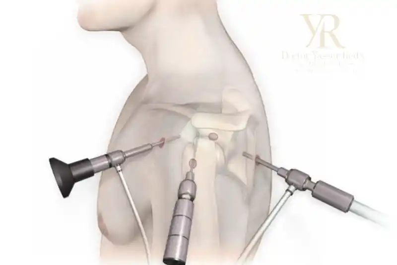 تكلفة منظار الكتف الجراحى في مصر