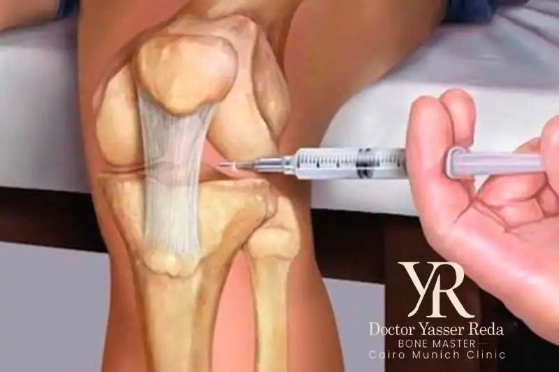 خطوات حقن الركبة بالمادة الجيلاتينية