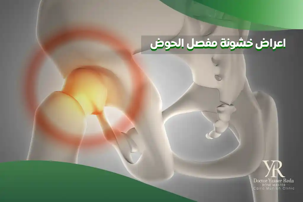 اعراض خشونة مفصل الحوض