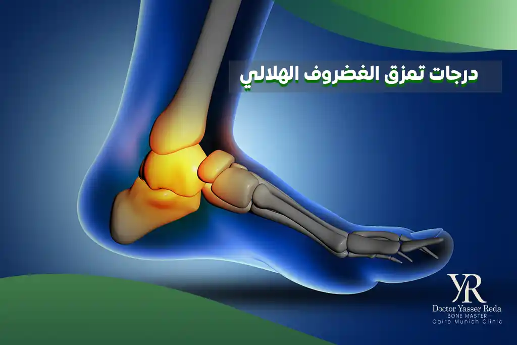 درجات تمزق الغضروف الهلالي