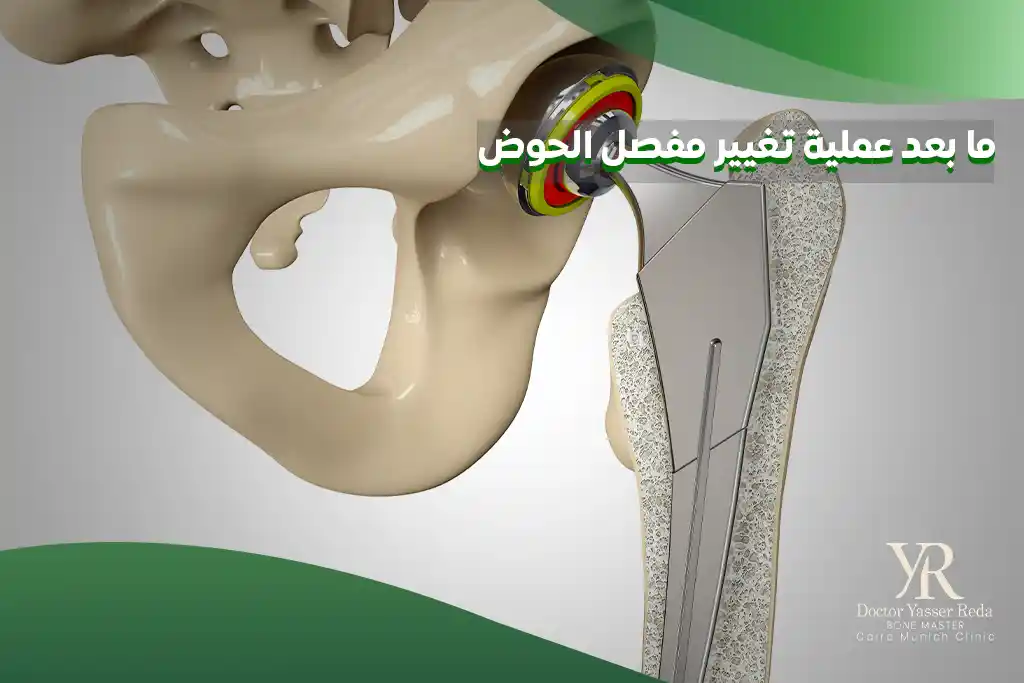 ما بعد عملية تغيير مفصل الحوض